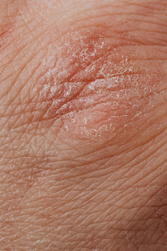 Understanding Psoriasis and the Role of Supplements in Managing It